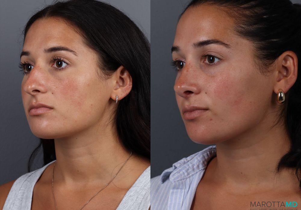 Rhinoplasty - Thumbnail 4