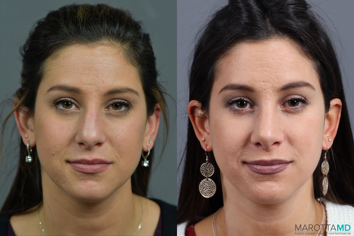 Before and after Rhinoplasty case 17407