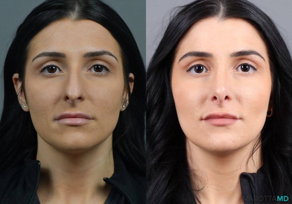 Rhinoplasty - Case 269