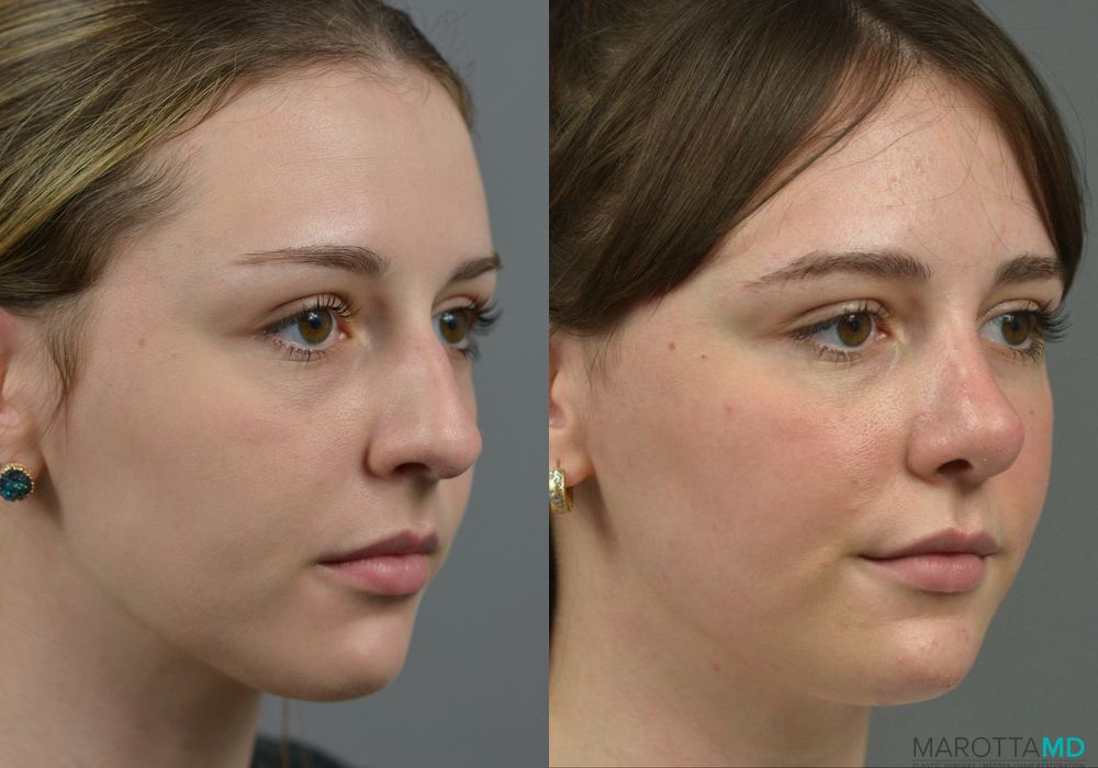 Rhinoplasty - Thumbnail 2