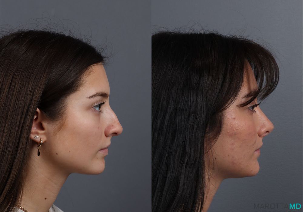 Rhinoplasty - Thumbnail 3