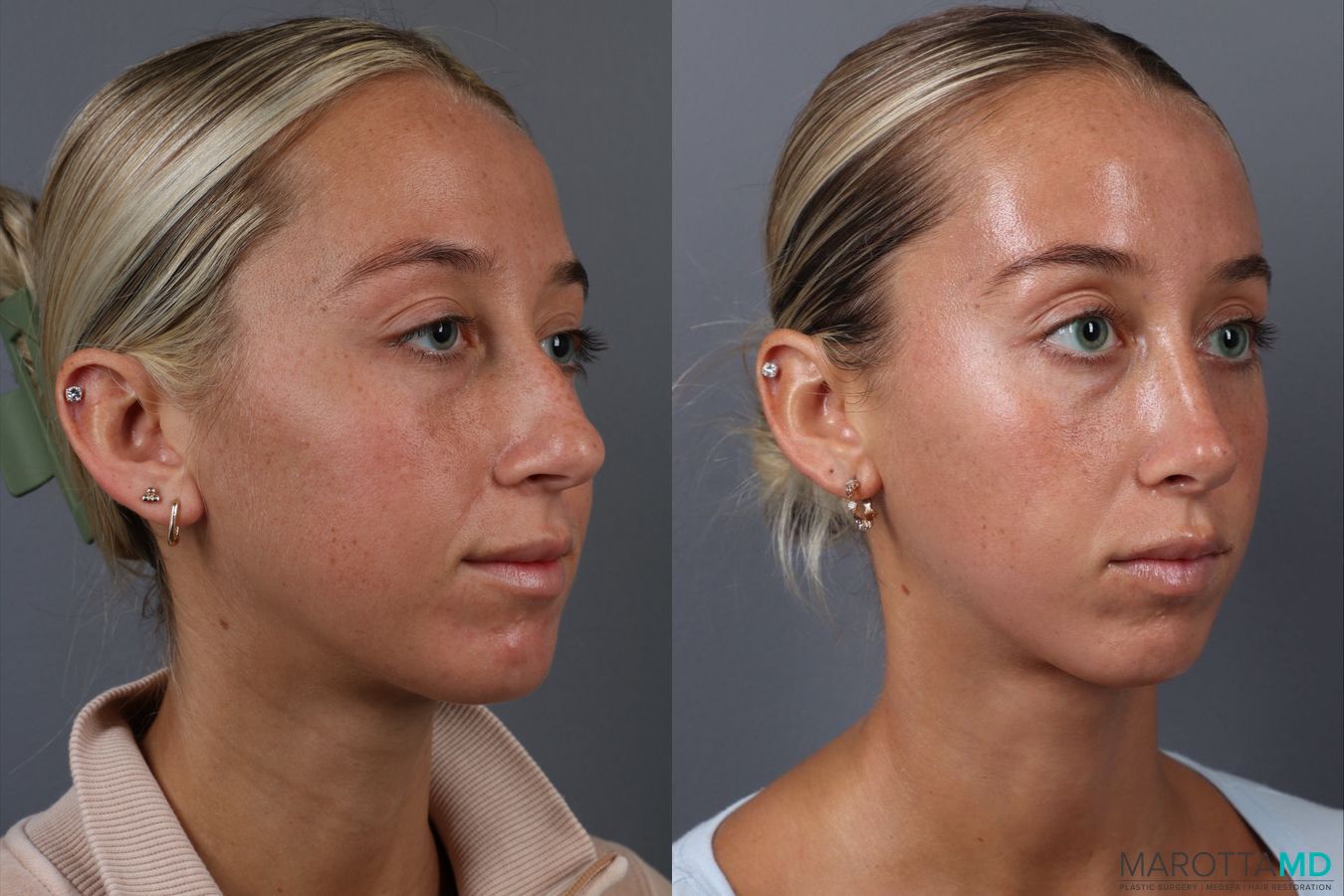 Before and after Rhinoplasty case 18368 - Angle 2