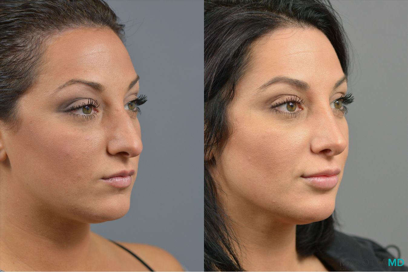 Before and after Rhinoplasty case 41921 - Angle 2