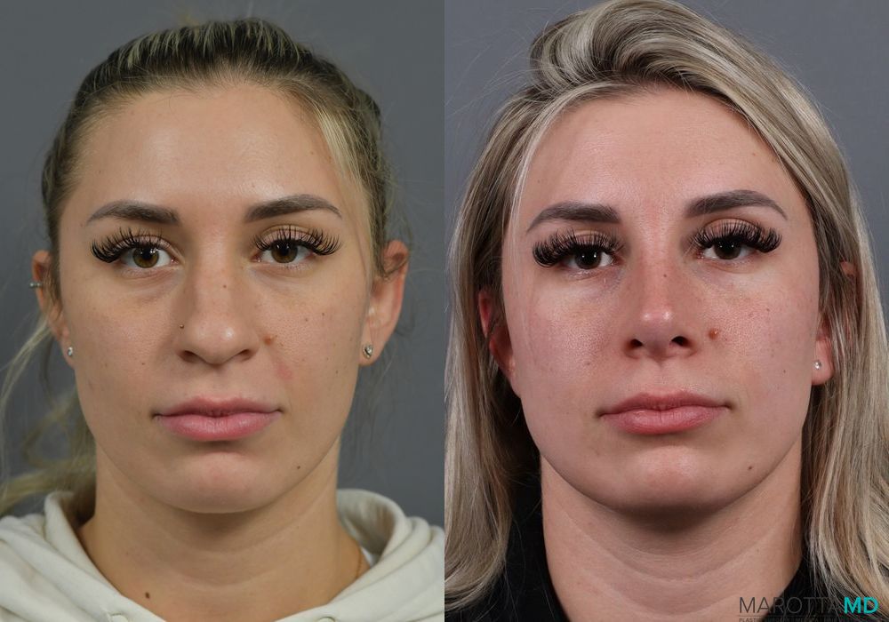 Before and after Rhinoplasty case 7284