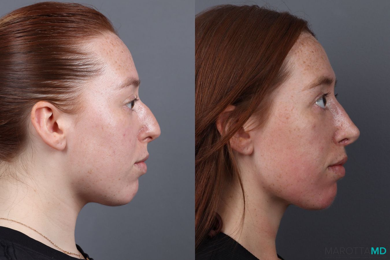 Before and after Rhinoplasty case 19923 - Angle 3