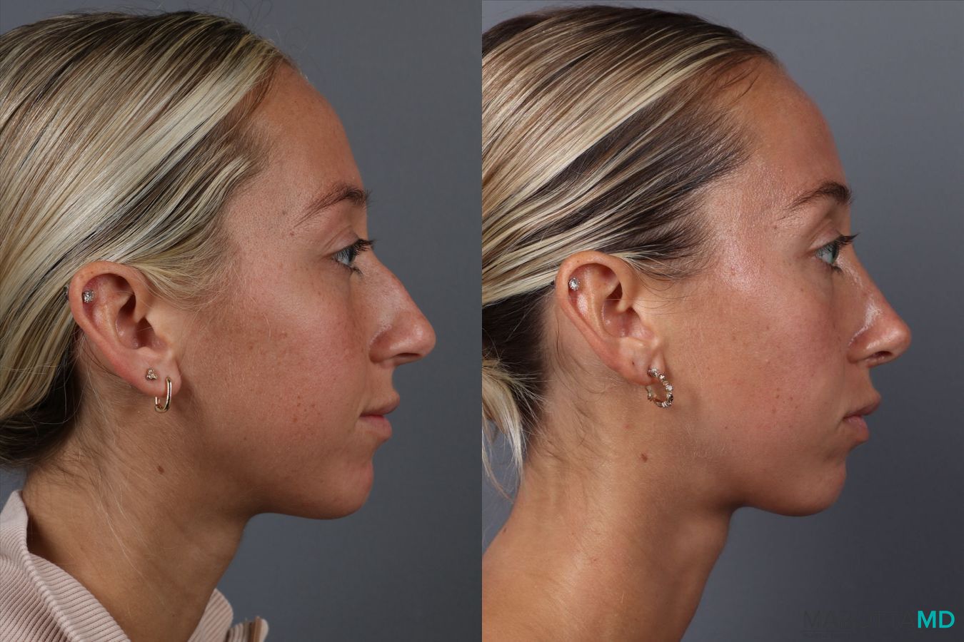 Before and after Rhinoplasty case 18368 - Angle 3