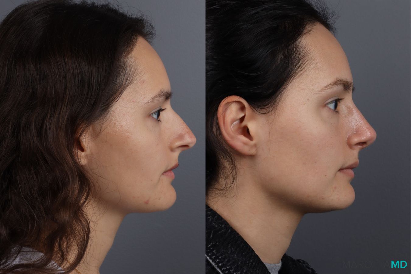 Before and after Rhinoplasty case 13237 - Angle 3