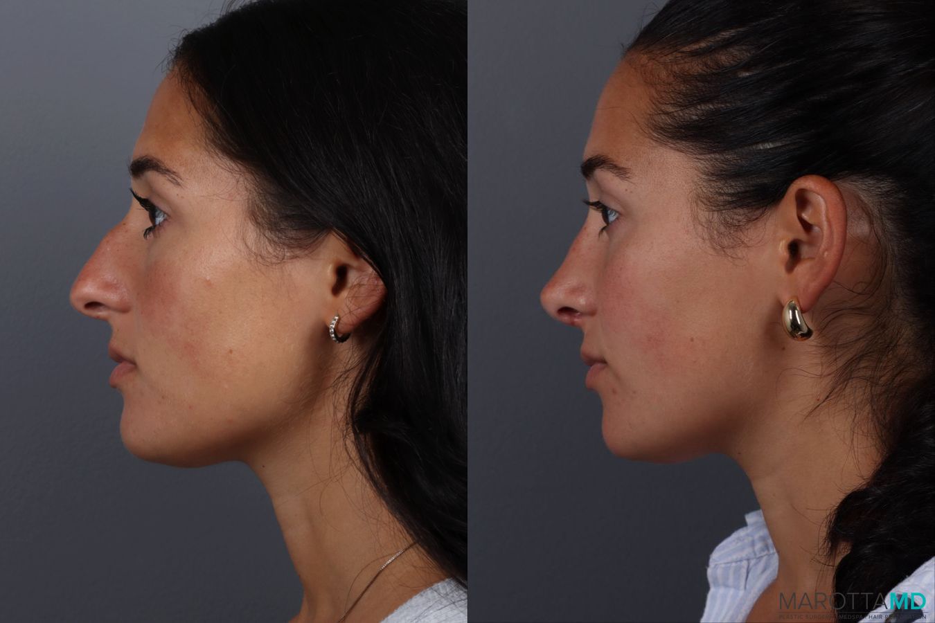Before and after Rhinoplasty case 19687 - Angle 5
