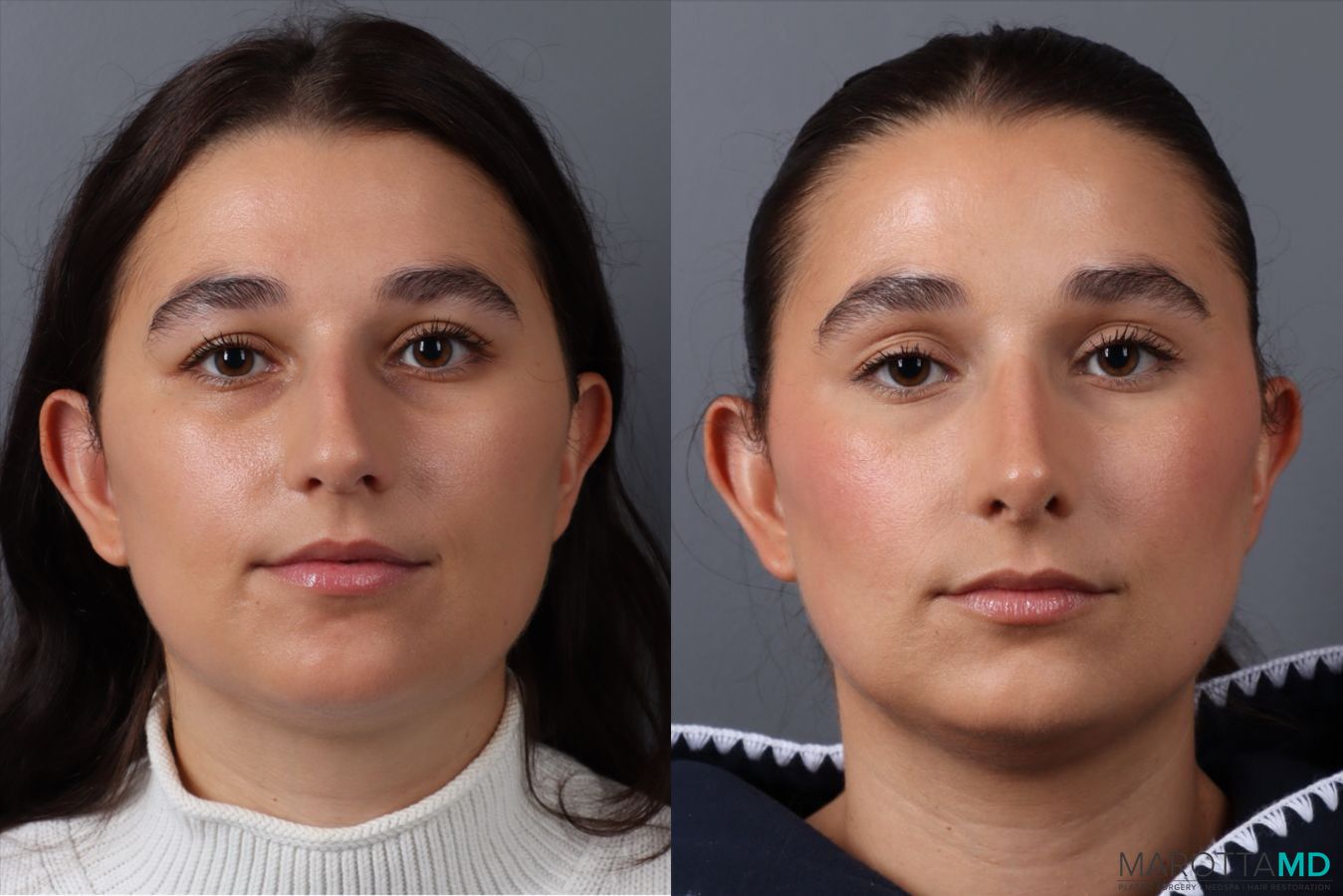 Before and after Rhinoplasty case 43704
