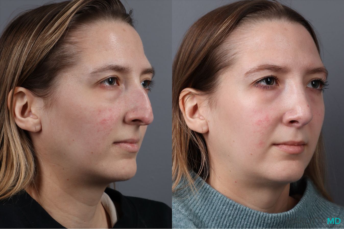 Before and after Rhinoplasty case 41762 - Angle 2