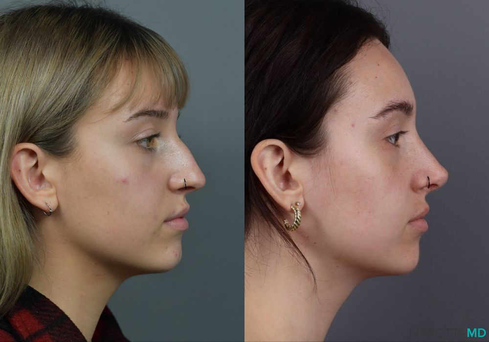 Rhinoplasty - Thumbnail 3