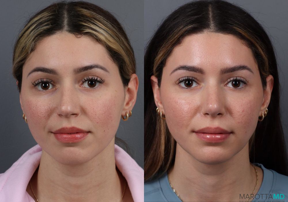 Rhinoplasty - Case 244