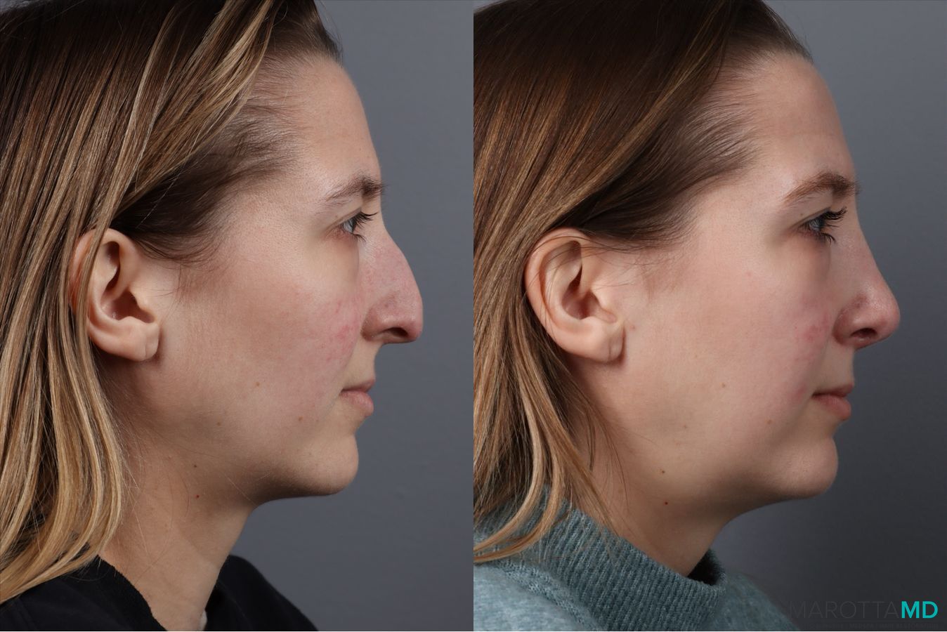 Before and after Rhinoplasty case 41762 - Angle 4