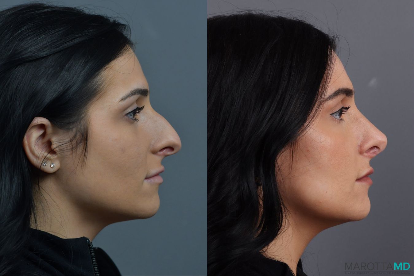 Before and after Rhinoplasty case 17406 - Angle 3