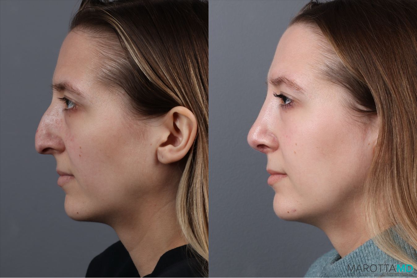 Before and after Rhinoplasty case 41762 - Angle 5