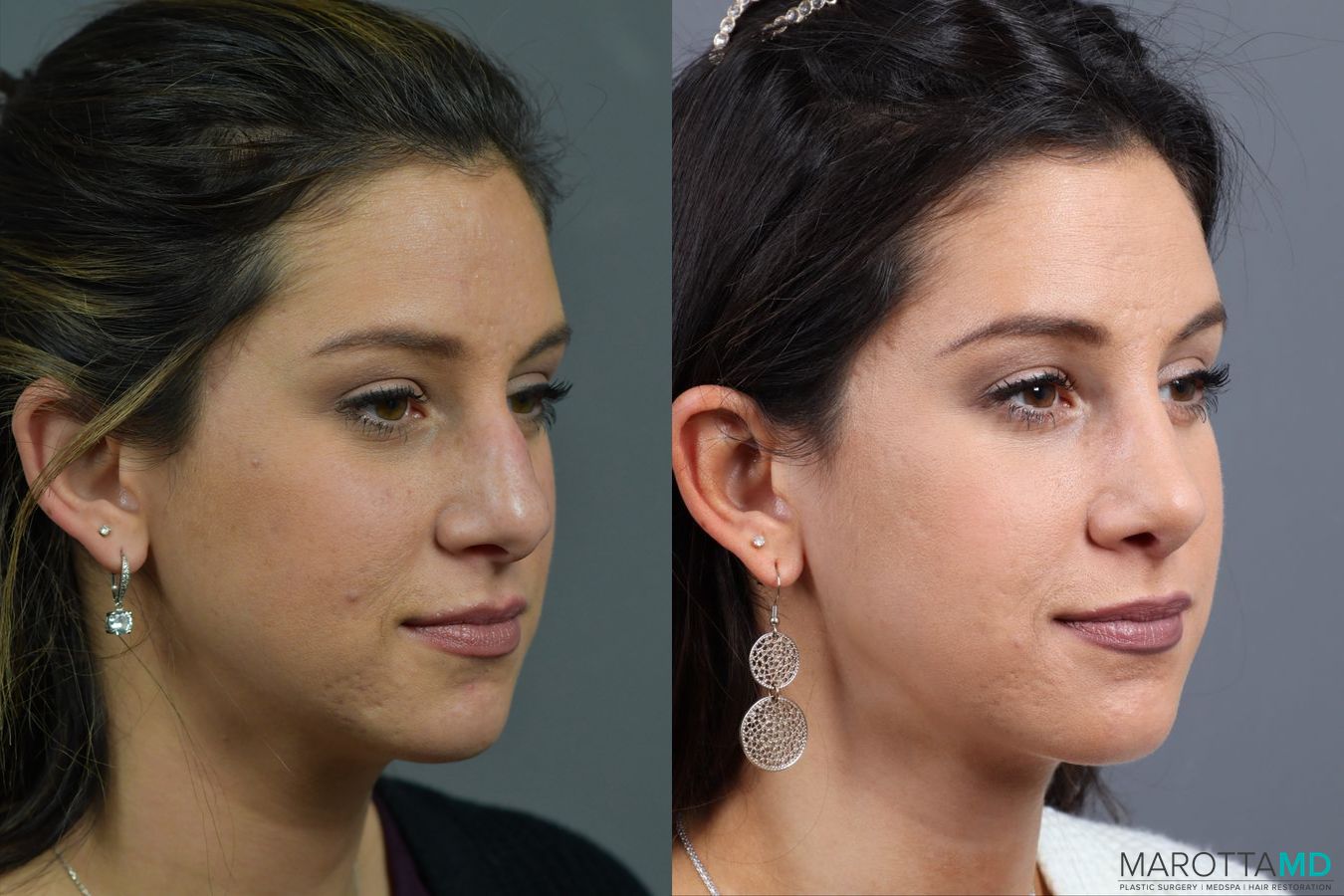 Before and after Rhinoplasty case 17407 - Angle 2