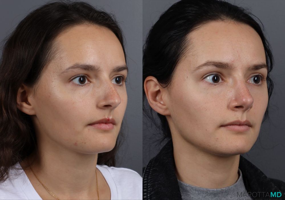 Rhinoplasty - Case 247