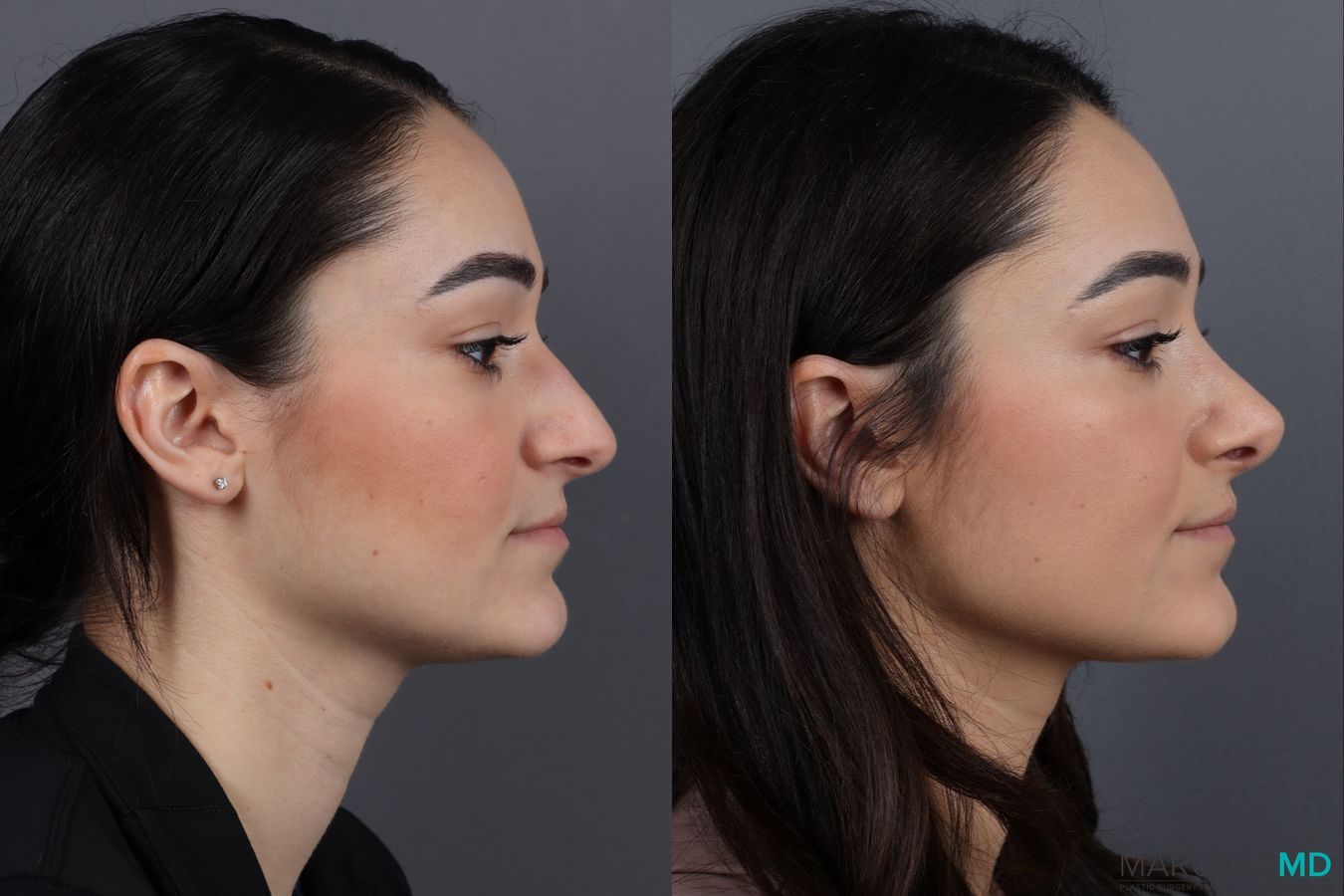 Before and after Rhinoplasty case 13004 - Angle 3