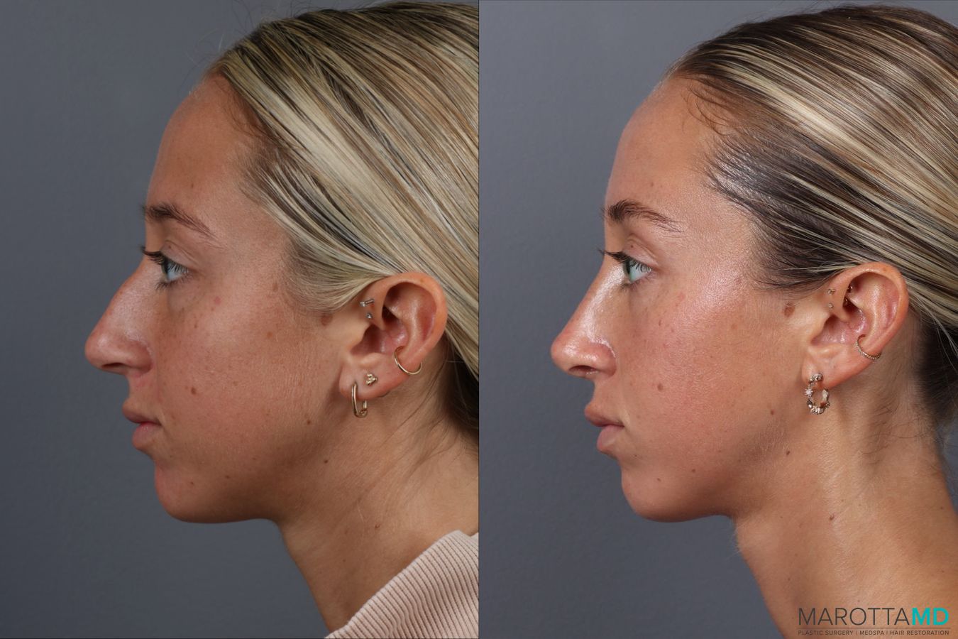 Before and after Rhinoplasty case 18368 - Angle 5