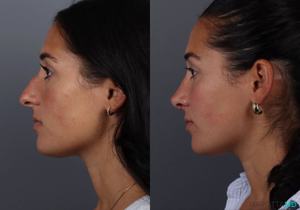 Rhinoplasty - Thumbnail 5