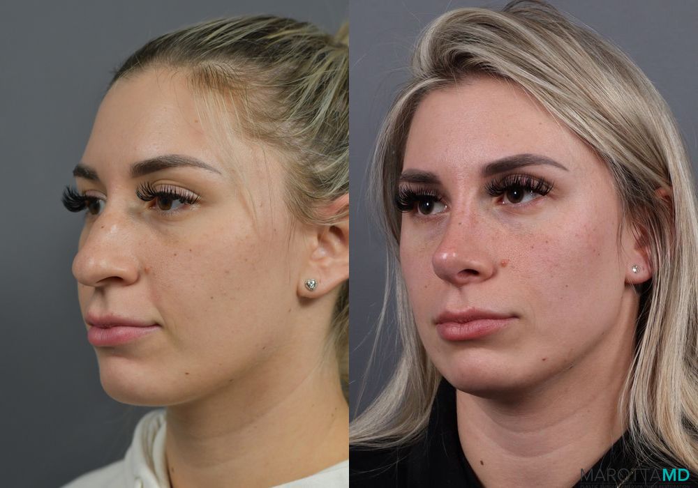 Before and after Rhinoplasty case 7284 - Angle 4