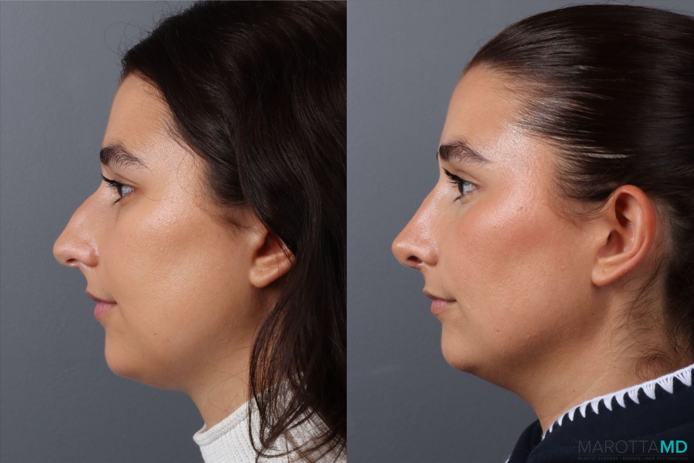 Before and after Rhinoplasty case 43704 - Angle 5