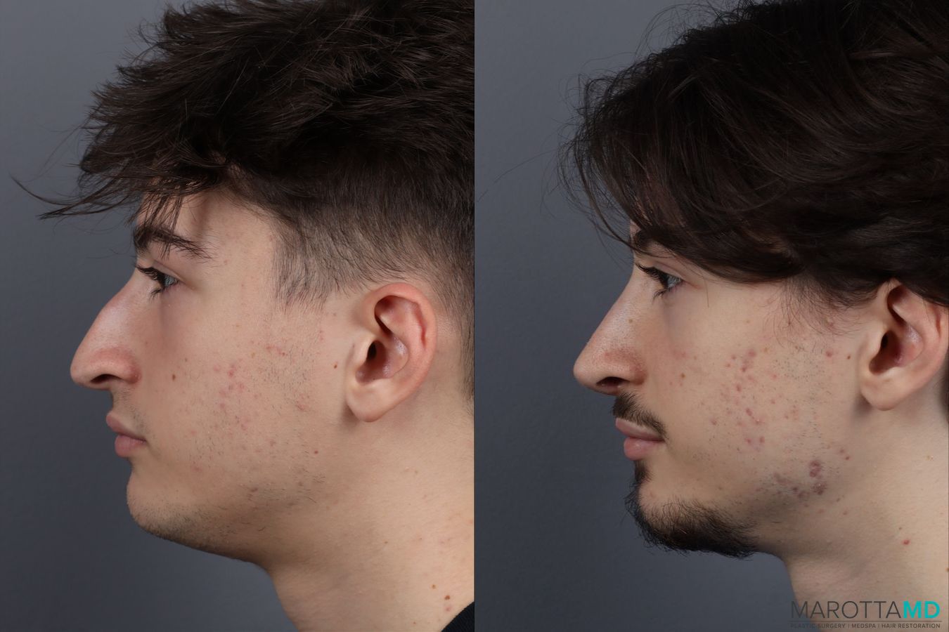 Before and after Rhinoplasty case 12828 - Angle 5