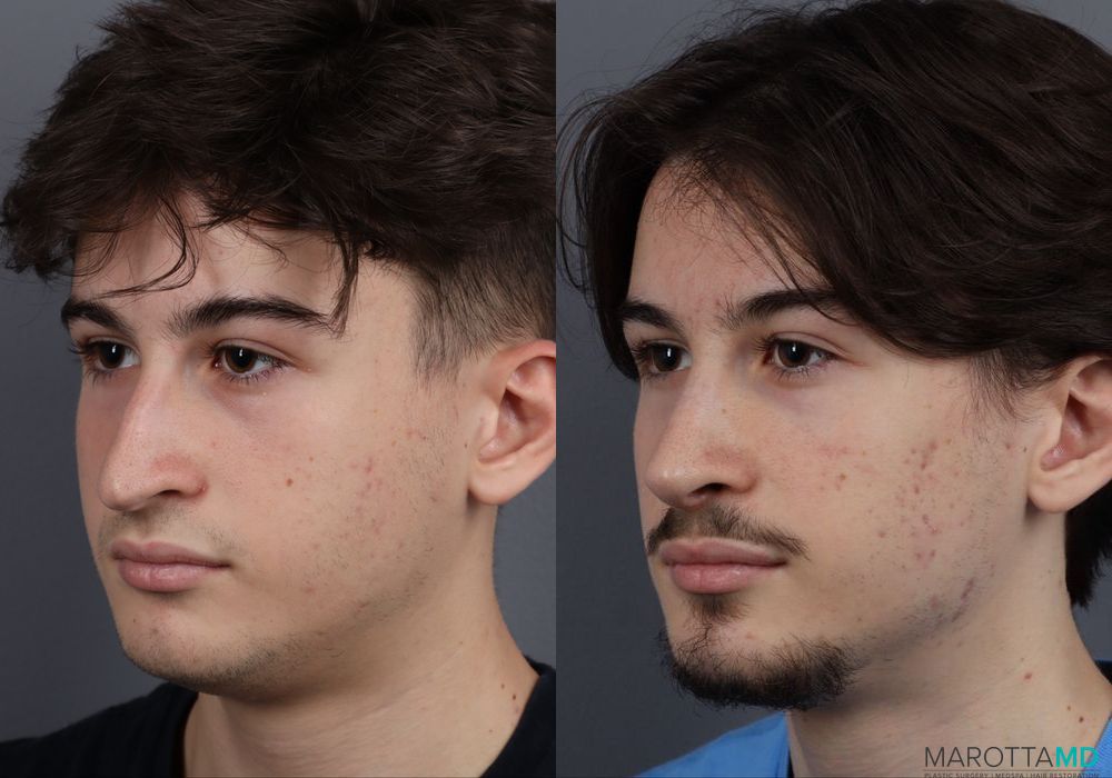 Rhinoplasty - Thumbnail 3