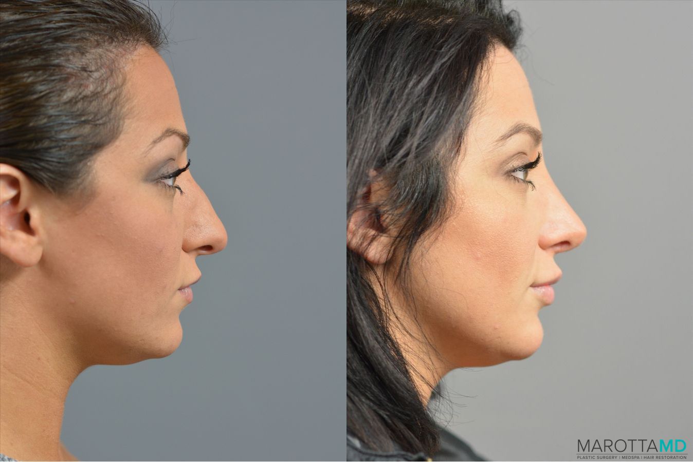 Before and after Rhinoplasty case 41921 - Angle 3