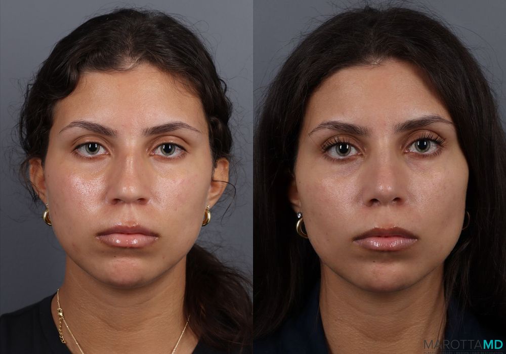 Rhinoplasty - Thumbnail 2