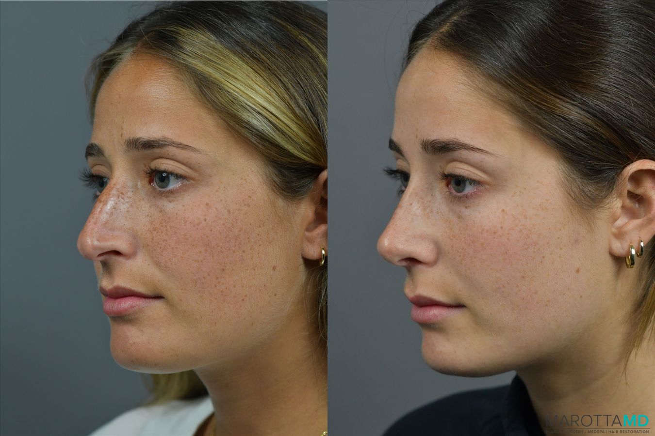 Before and after Rhinoplasty case 41923 - Angle 2