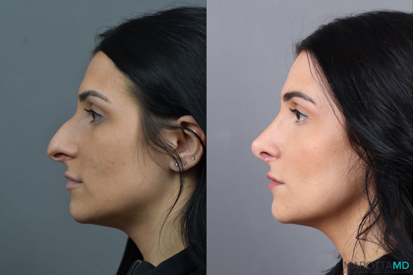 Before and after Rhinoplasty case 17406 - Angle 5