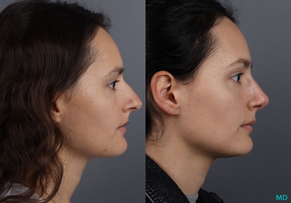 Rhinoplasty - Thumbnail 5