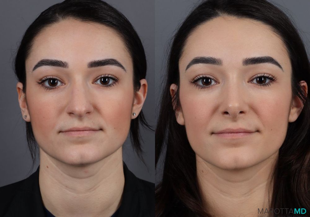 Rhinoplasty - Thumbnail 2