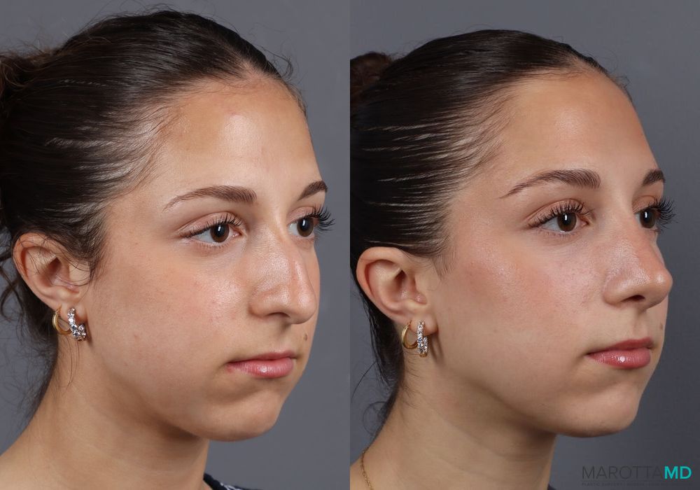 Before and after Rhinoplasty case 7139 - Angle 4
