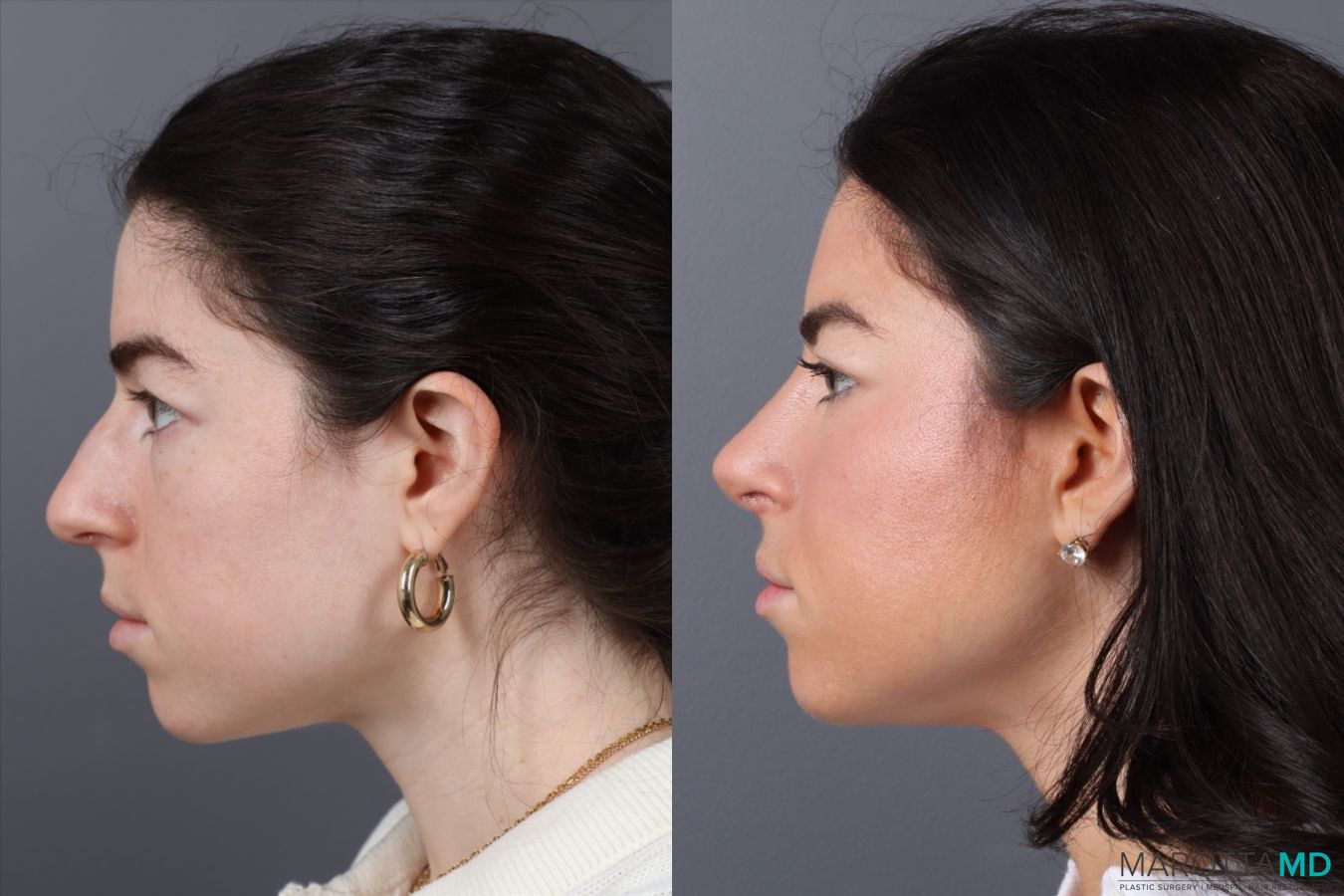Before and after Rhinoplasty case 43707 - Angle 4
