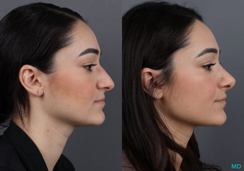 Rhinoplasty - Thumbnail 4