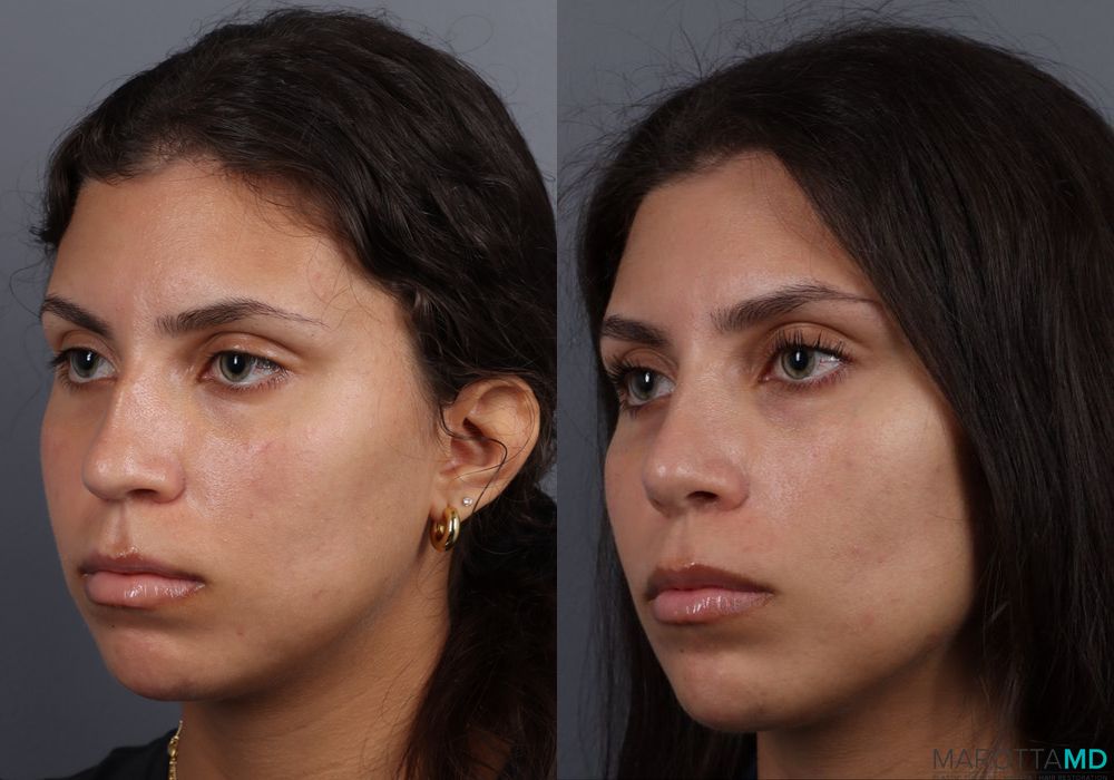 Rhinoplasty - Thumbnail 3