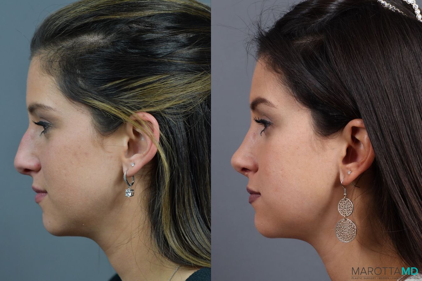 Before and after Rhinoplasty case 17407 - Angle 5