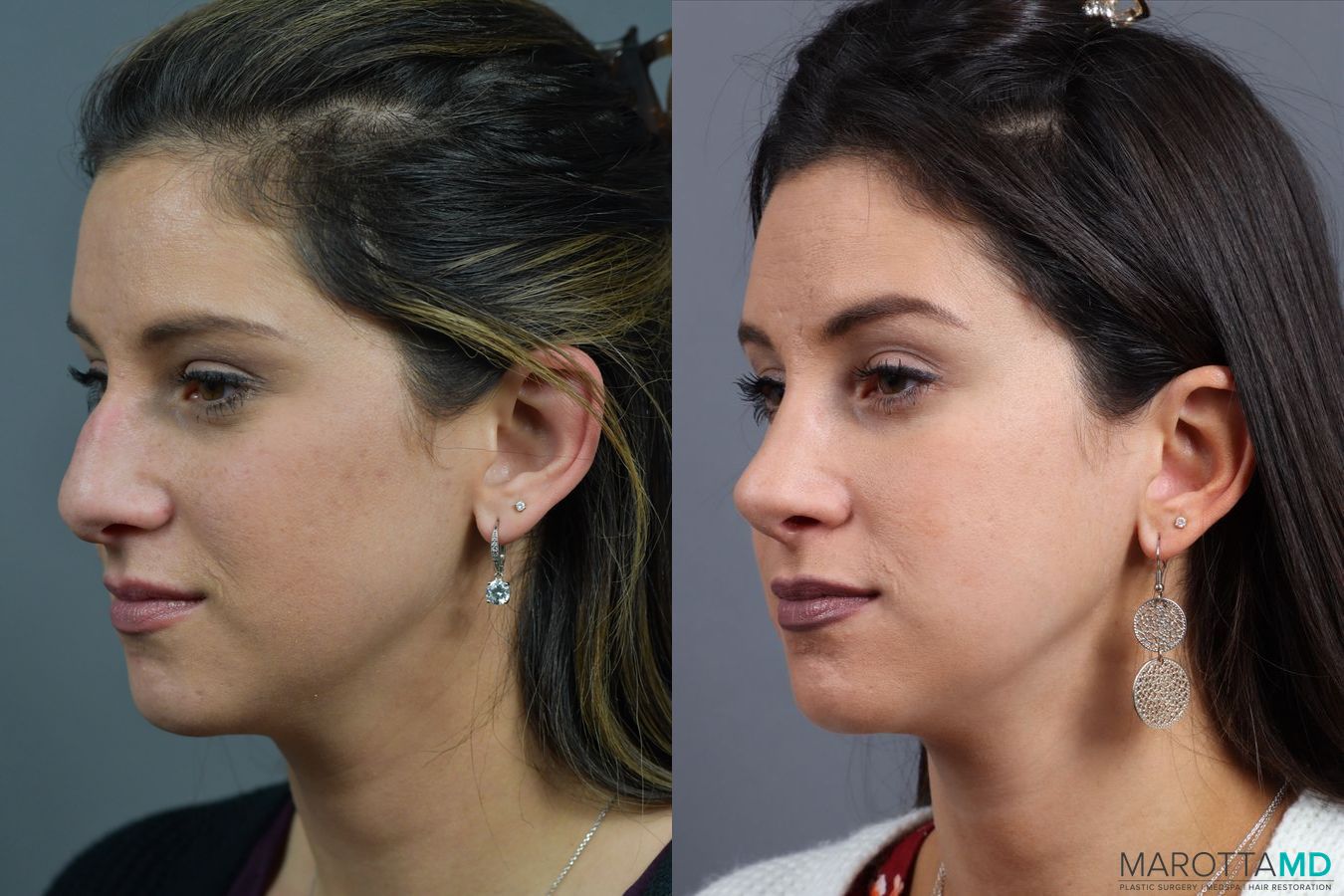 Before and after Rhinoplasty case 17407 - Angle 4