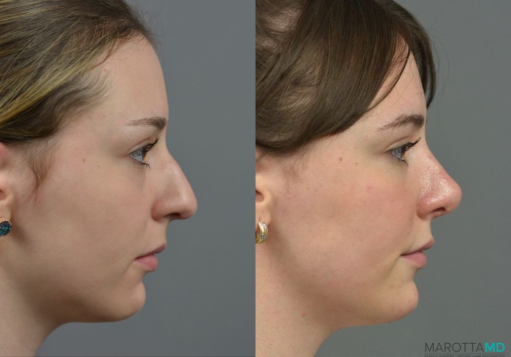 Rhinoplasty - Thumbnail 3