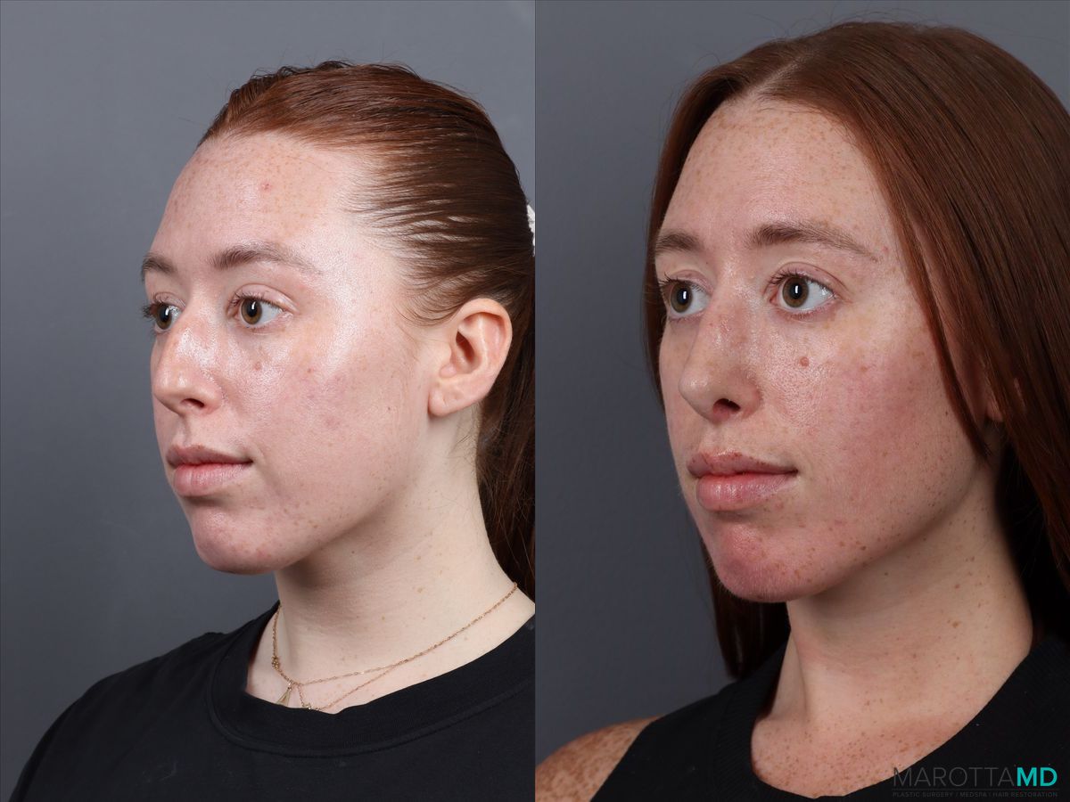 Before and after Rhinoplasty case 19923 - Angle 4