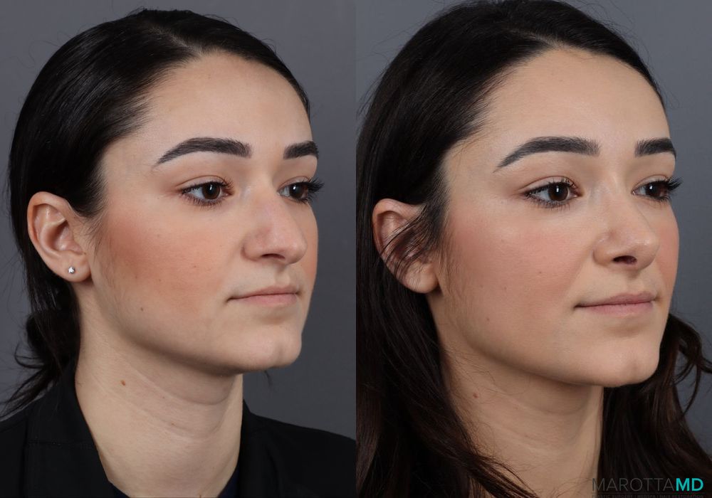 Rhinoplasty - Thumbnail 3
