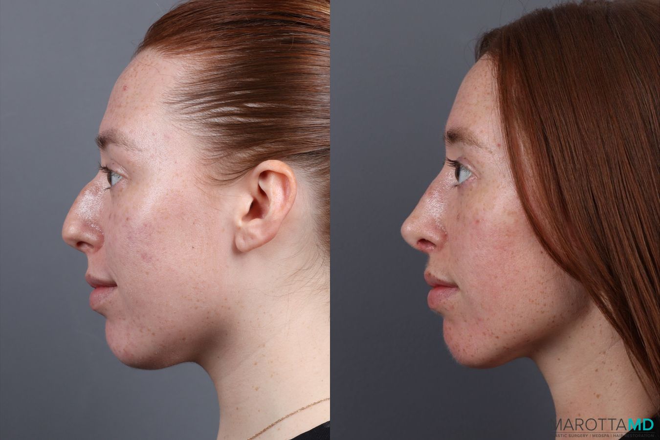 Before and after Rhinoplasty case 19923 - Angle 5
