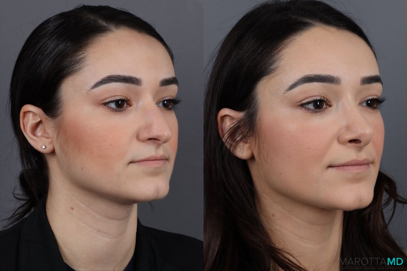 Before and after Rhinoplasty case 13004 - Angle 2
