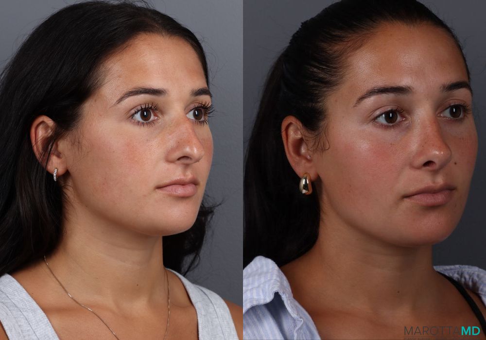 Rhinoplasty - Thumbnail 2