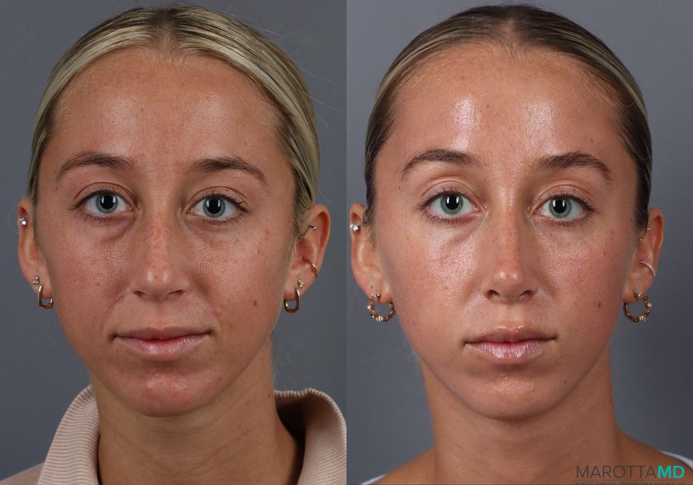 Rhinoplasty - Case 271