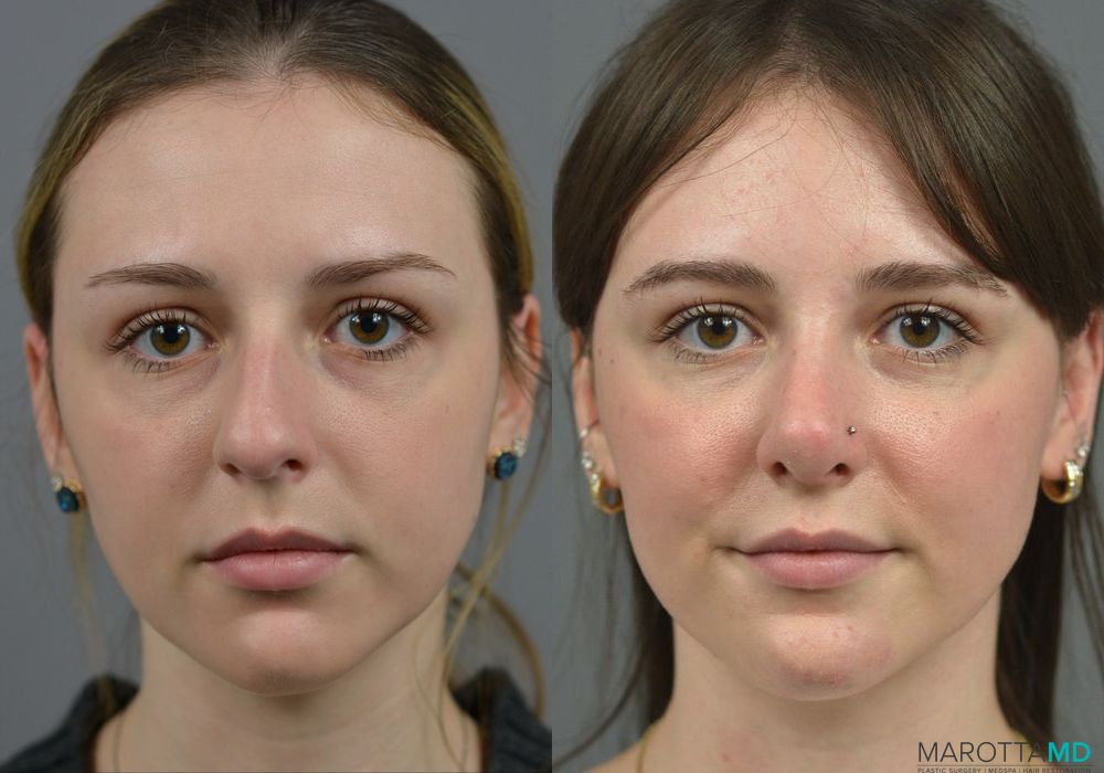 Rhinoplasty - Case 1067