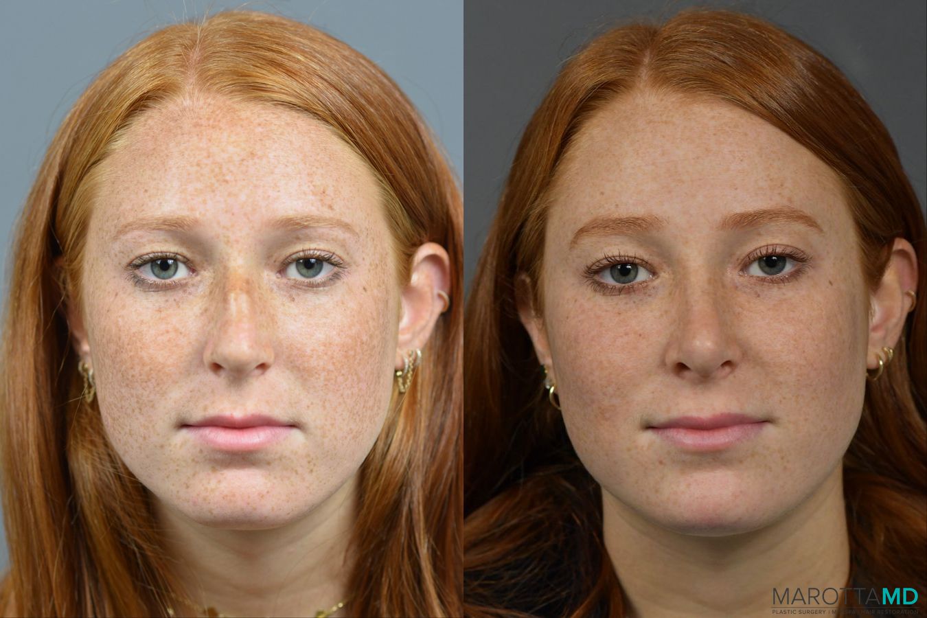 Before and after Rhinoplasty case 16102