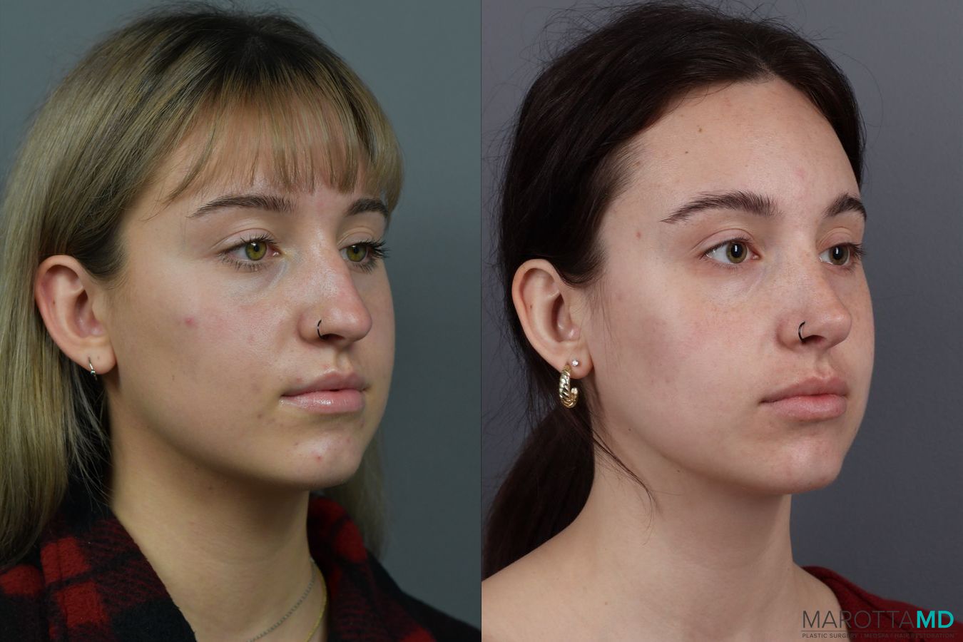 Before and after Rhinoplasty case 12317 - Angle 2